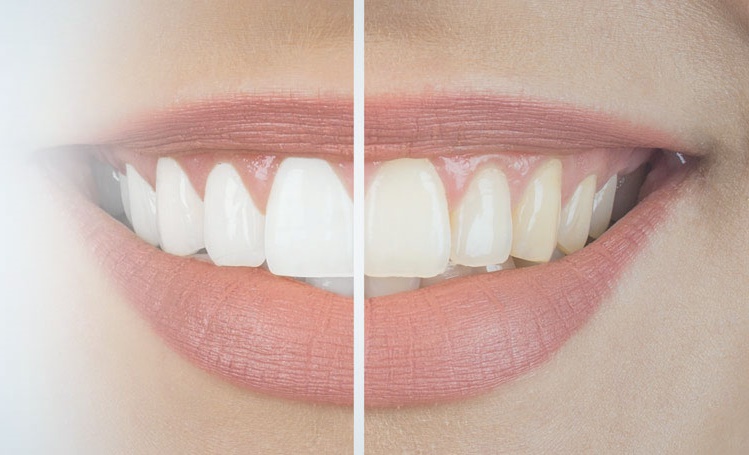 Ankara Beytepe Beyazlatma Tedavisi ve Güncel Fiyatları - Gürses Dental