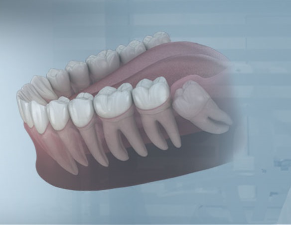 Ankara Beytepe Gömülü 20 Yaş Dişi Çekimi ve Tedavisi - Gürses Dental