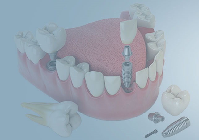 Ankara Beytepe İmplant Diş Tedavisi ve Güncel Fiyatları - Gürses Dental