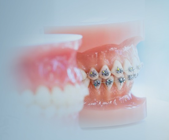 Ankara Beytepe Ortodonti Diş Teli Tedavisi ve Güncel Fiyatları - Gürses Dental
